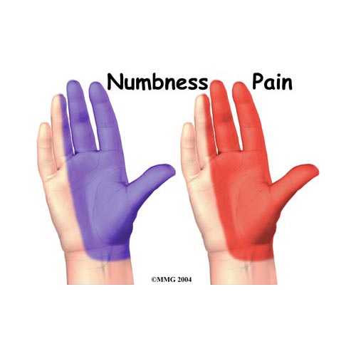 carpal tunnel numbness and pain location